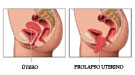 Tratamiento del prolapso uterino