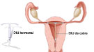 Cómo se coloca el DIU