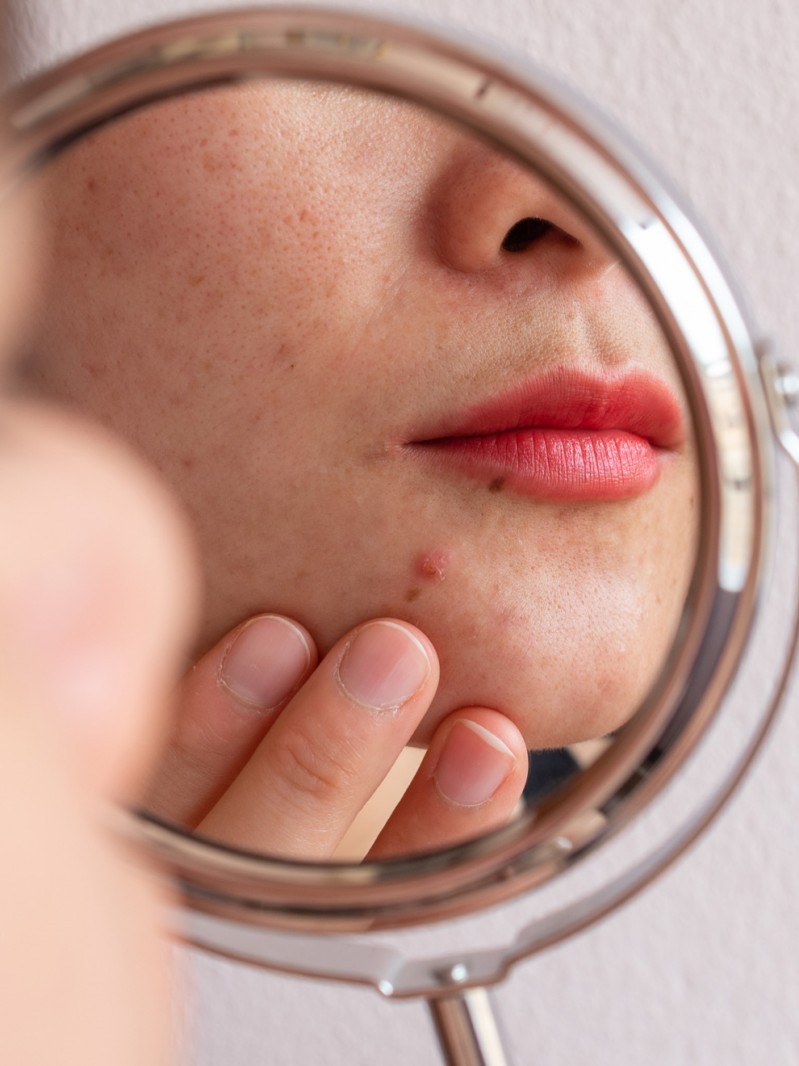 Factores que más influyen en la aparición de granos: causas del acné