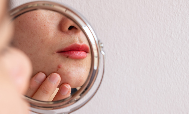 Razones y causas de la aparición de acné