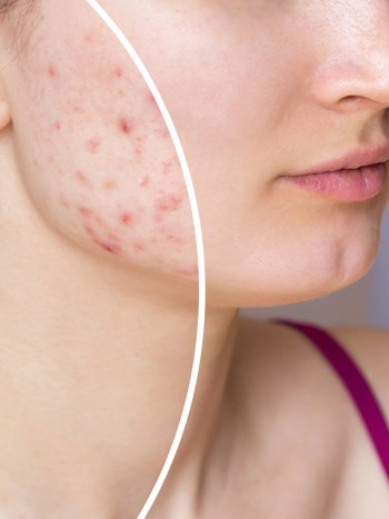 Tratamiento facial con ácido bórico para acné y quemaduras: ¿funciona?