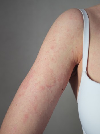 Granitos en los brazos: causas y tratamiento de la foliculitis