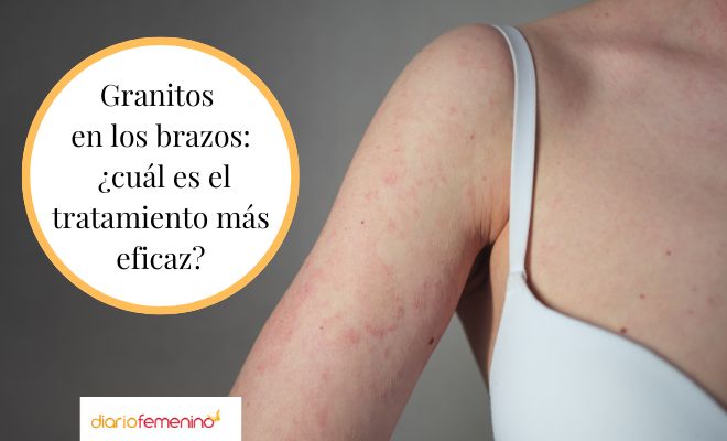 Causas y tratamiento de la foliculitis o granitos en los brazos