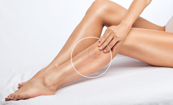 ¿Puedes tatuarte si tienes varices?