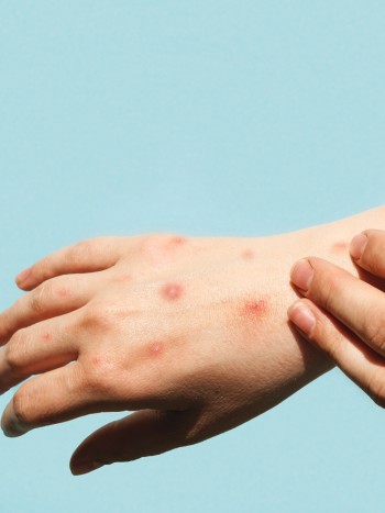 Soñar con tener varicela: el peligro del contagio