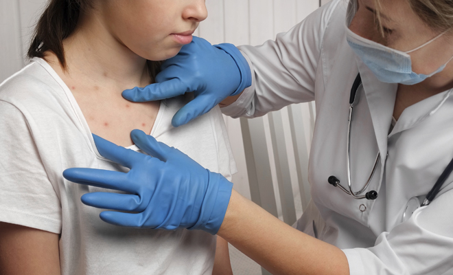 Distintas interpretaciones de soñar con tener varicela