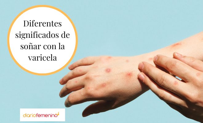 Todos los significados de soñar con la varicela