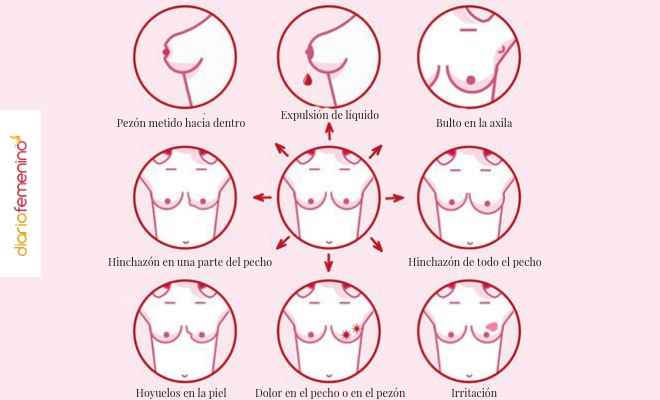 Los principales síntomas del cáncer de mama