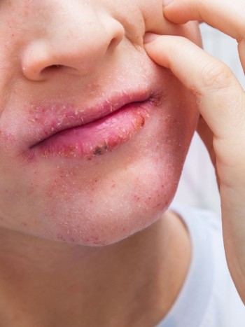 Síndrome de la boca seca por ansiedad: combate el mal aliento