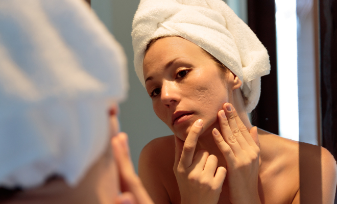 Causas por las que aparece el acné a los 30 años