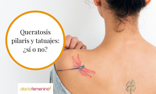 Queratosis pilaris y tatuajes: ¿incompatibles?