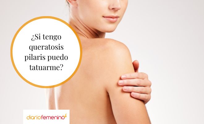 ¿Es recomendable hacerse un tatuaje si tienes queratosis pilaris