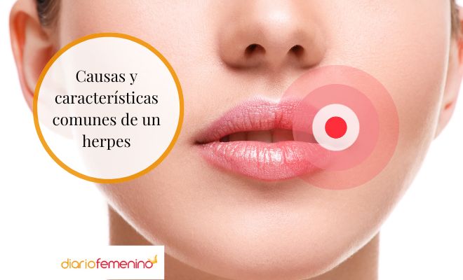Causas y características de un herpes