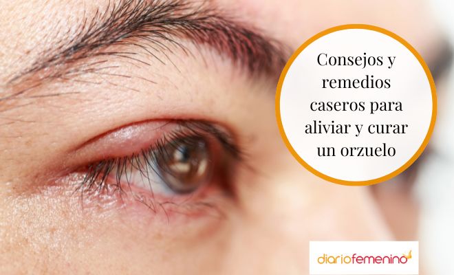 ¿Cómo aliviar y tratar un orzuelo?