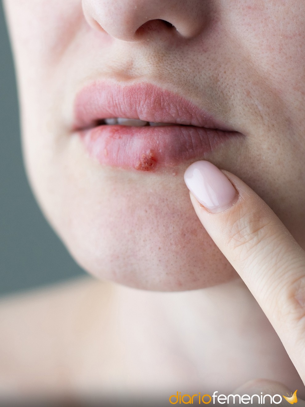 herpes labial significado herpes labial significado