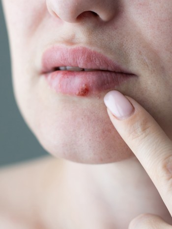 ¿Puede el estrés provocar herpes?