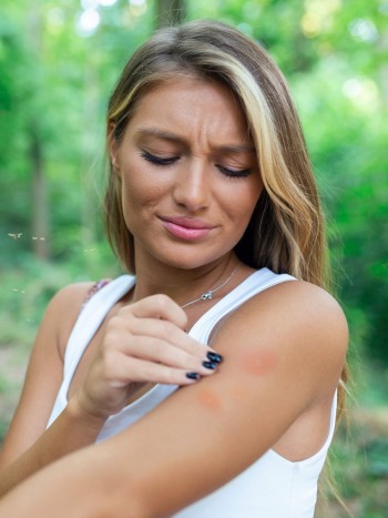 Remedios caseros efectivos para aliviar las picaduras de mosquito
