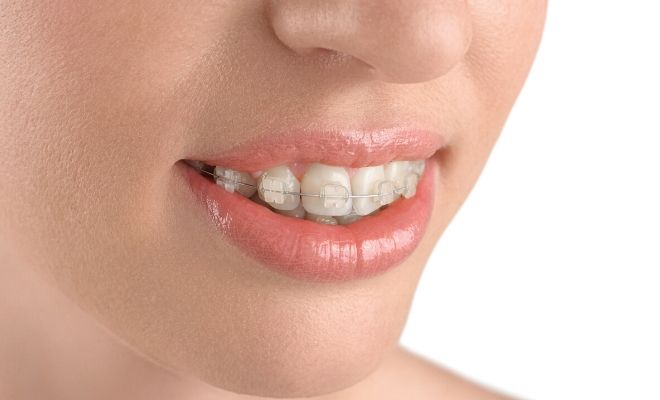 Qué cuidados necesitan los brackets