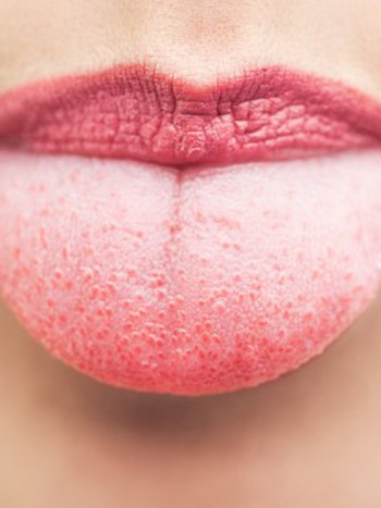 Granos en la lengua: ¿por qué aparecen?