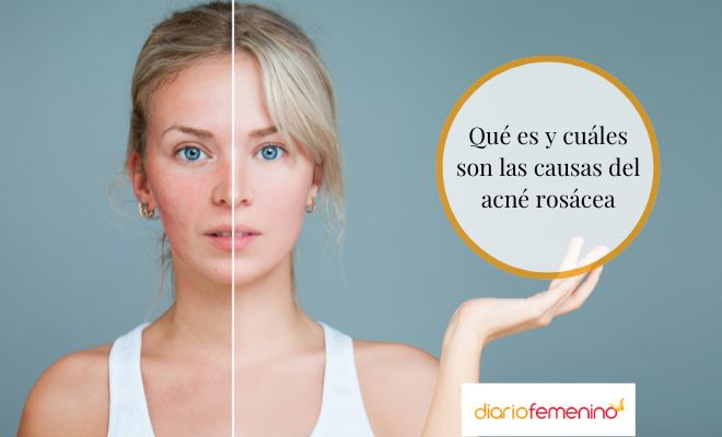 Causas del acné rosácea
