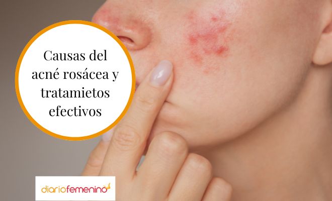 Causas y tratamientos del acné rosácea que debes conocer