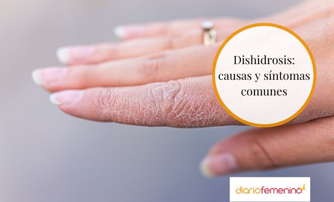 Cuáles son las causas y los síntomas de la dishidrosis