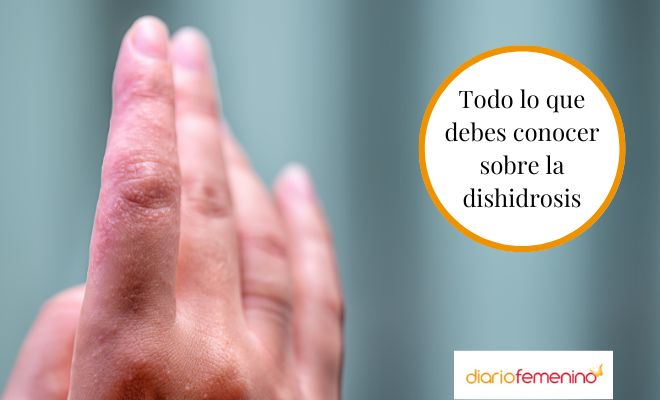 Causas, síntomas y tratamiento de la dishidrosis
