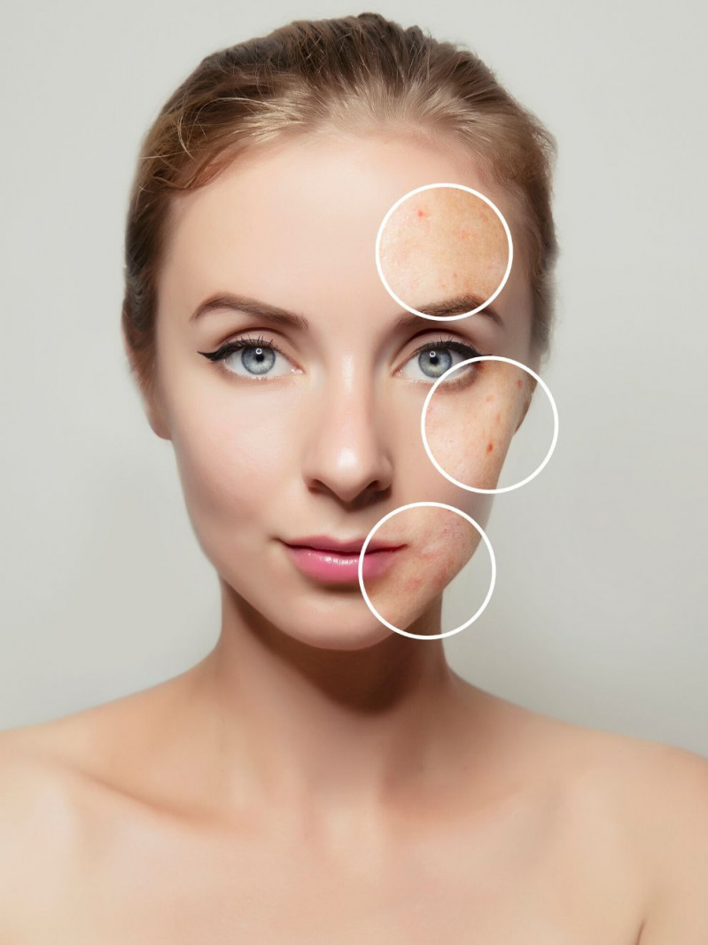 ¿Es normal tener granos a los 30 años? Así se trata el acné en adultos