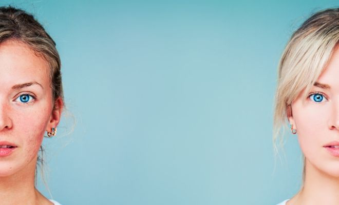 Tratamiento del acné en adultos: granos y espinillas a los 30 años