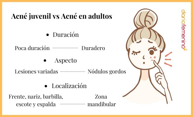 Diferencias entre el acné adulto y el acné juvenil