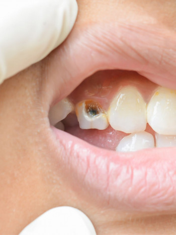 He soñado que tenía un diente picado y podrido, ¿debería preocuparme?