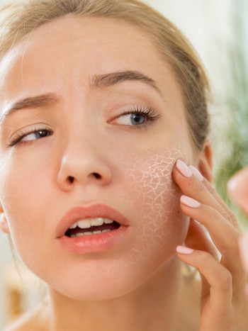 Baja autoestima por acné: cuando tener granos te mina mucho la moral