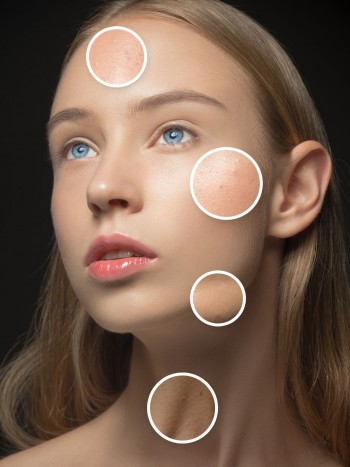 Acné en la frente, en la espalda... Los granos según zona del cuerpo