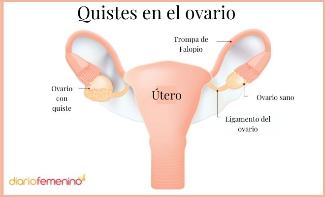Quistes De Ovario Cómo Saber Si Son Malignos Síntomas Y Tipos 7268
