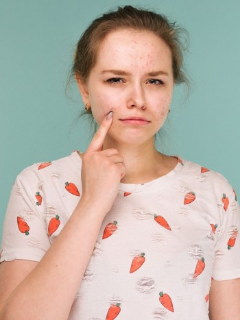 Causas del acné: ¿por qué me han salido granos y espinillas?