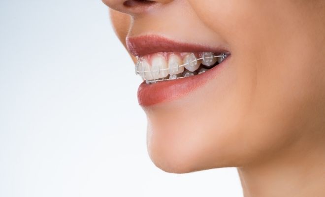 Todos los significados de soñar que se te caen los brackets