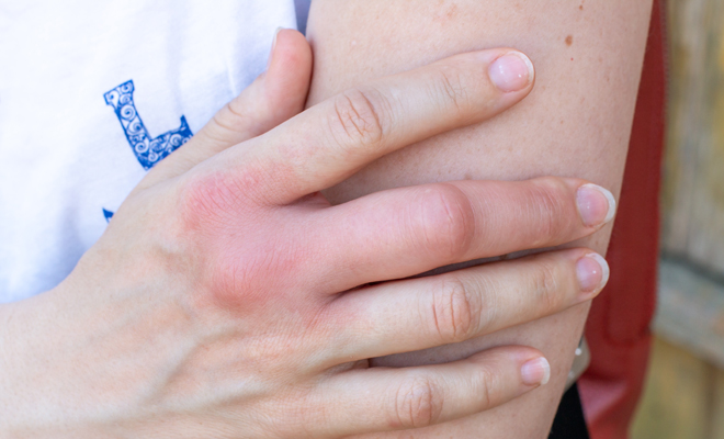 Qué significa soñar que una hormiga te pica 