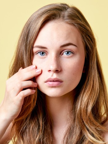 Manchas y cicatrices por los granos: cómo eliminar las marcas del acné