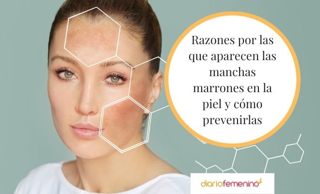 Manchas Marrones En La Piel: ¿por Qué Salen?