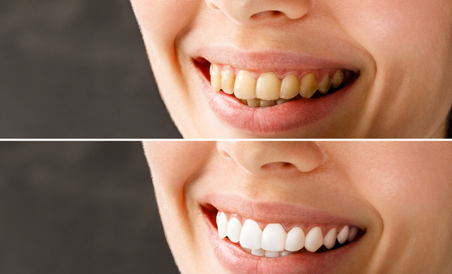 Significado de soñar con dientes flojos y sucios