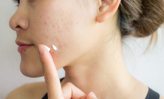 Consejos para tratar una piel con acné