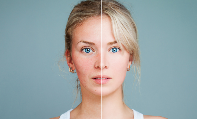 Los tipos de granos y de acné