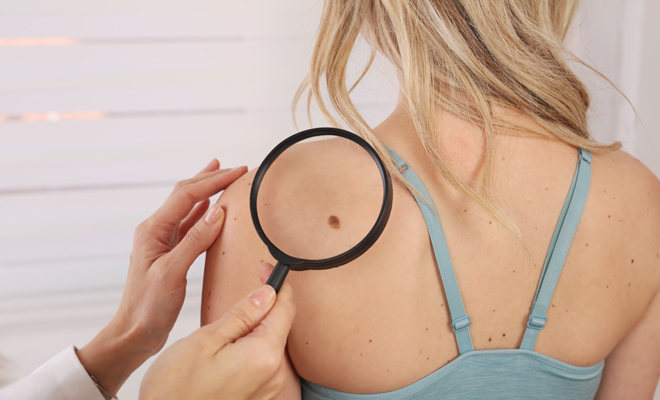 ¿Cómo y cuándo debes revisar tus lunares?