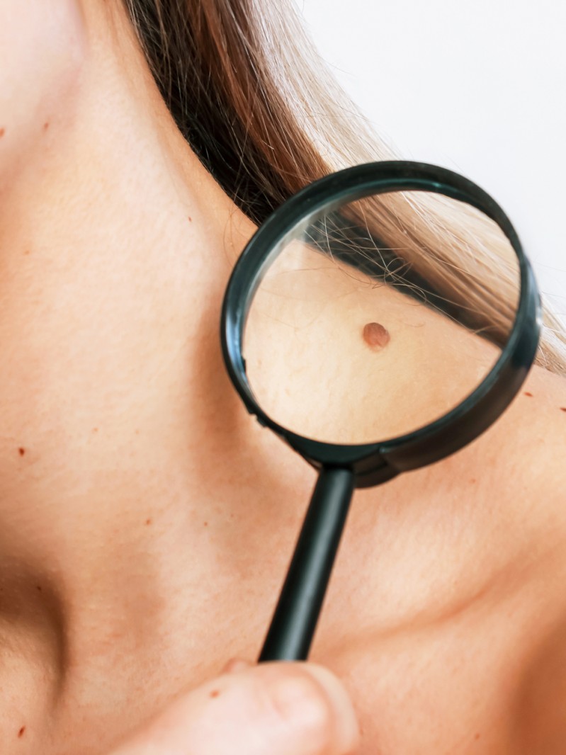 La regla del ABCDE para revisar lunares (y saber si son malignos o no)