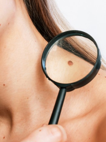 La regla del ABCDE para revisar lunares (y saber si son malignos o no)