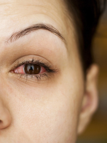 Tengo los ojos rojos, ¿qué me pasa? Causas y soluciones