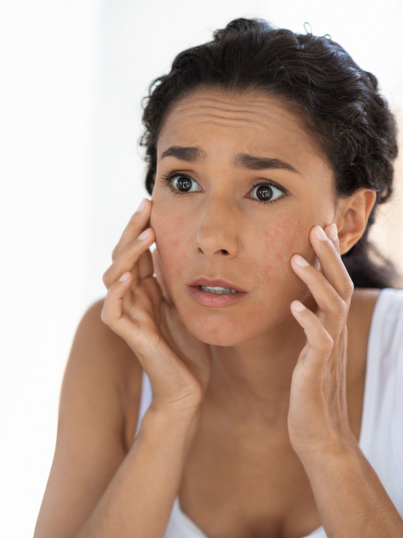 Cuál es el tratamiento más efectivo para el acné: tips de especialista