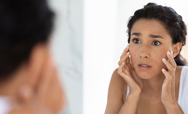 El tratamiento más efectivo para solucionar los problemas del acné