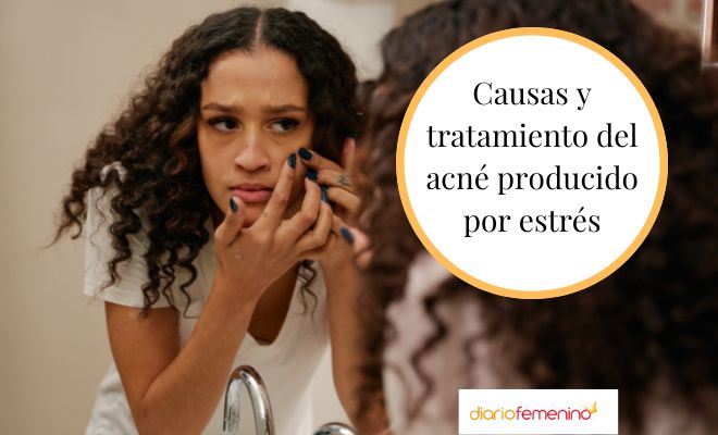 Acné producido por estrés: ¿cómo combatirlo?