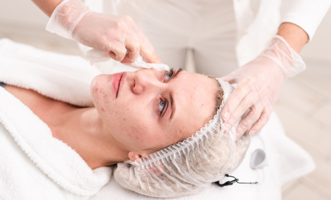 ¿Cómo se eliminan las cicatrices o manchas del acné?